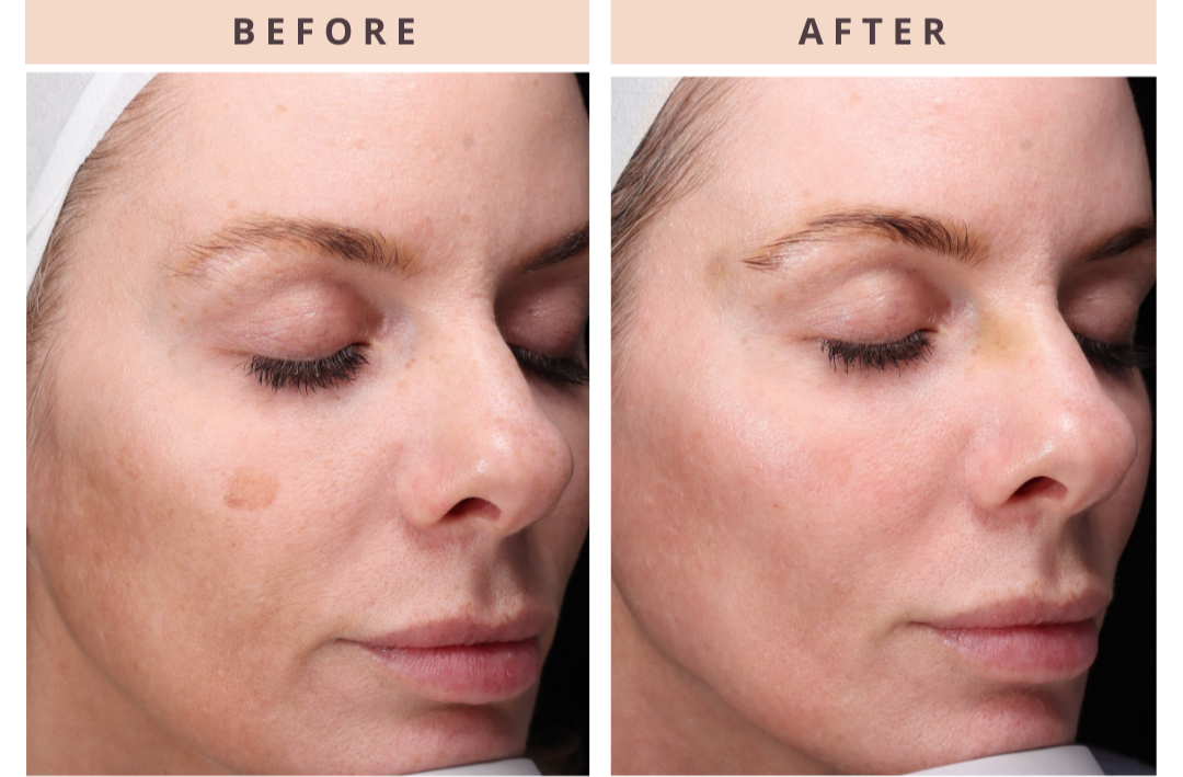 CoolPeel before and after showing the side of the face