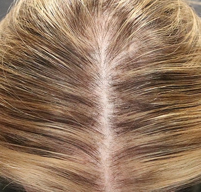 Alma TED official patient case 1, 2 Months Post 2 Txs
