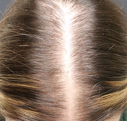 Alma TED official patient case 1, before treatment