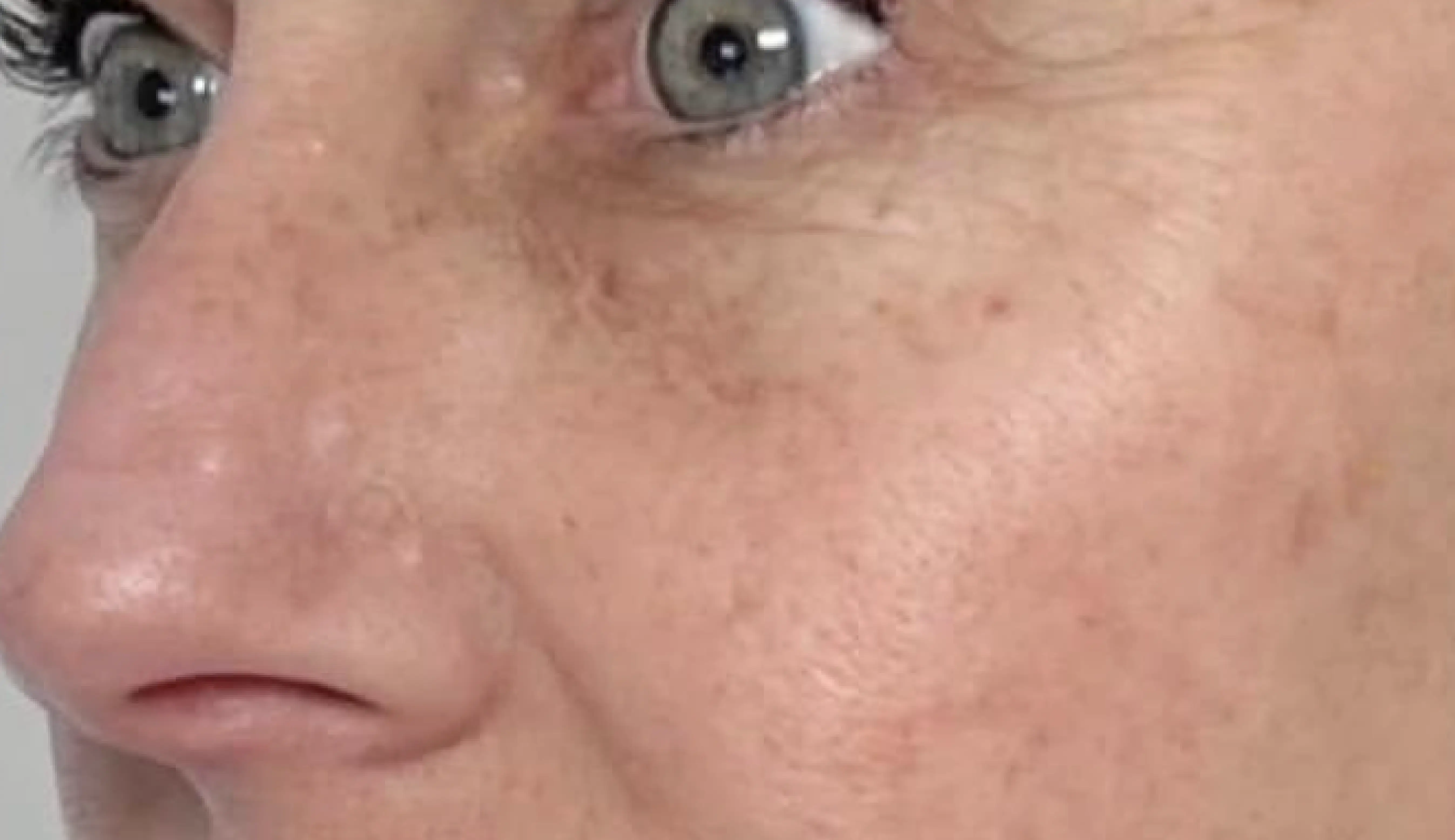 Official Clear + Brilliant patient 1, four weeks after three treatments