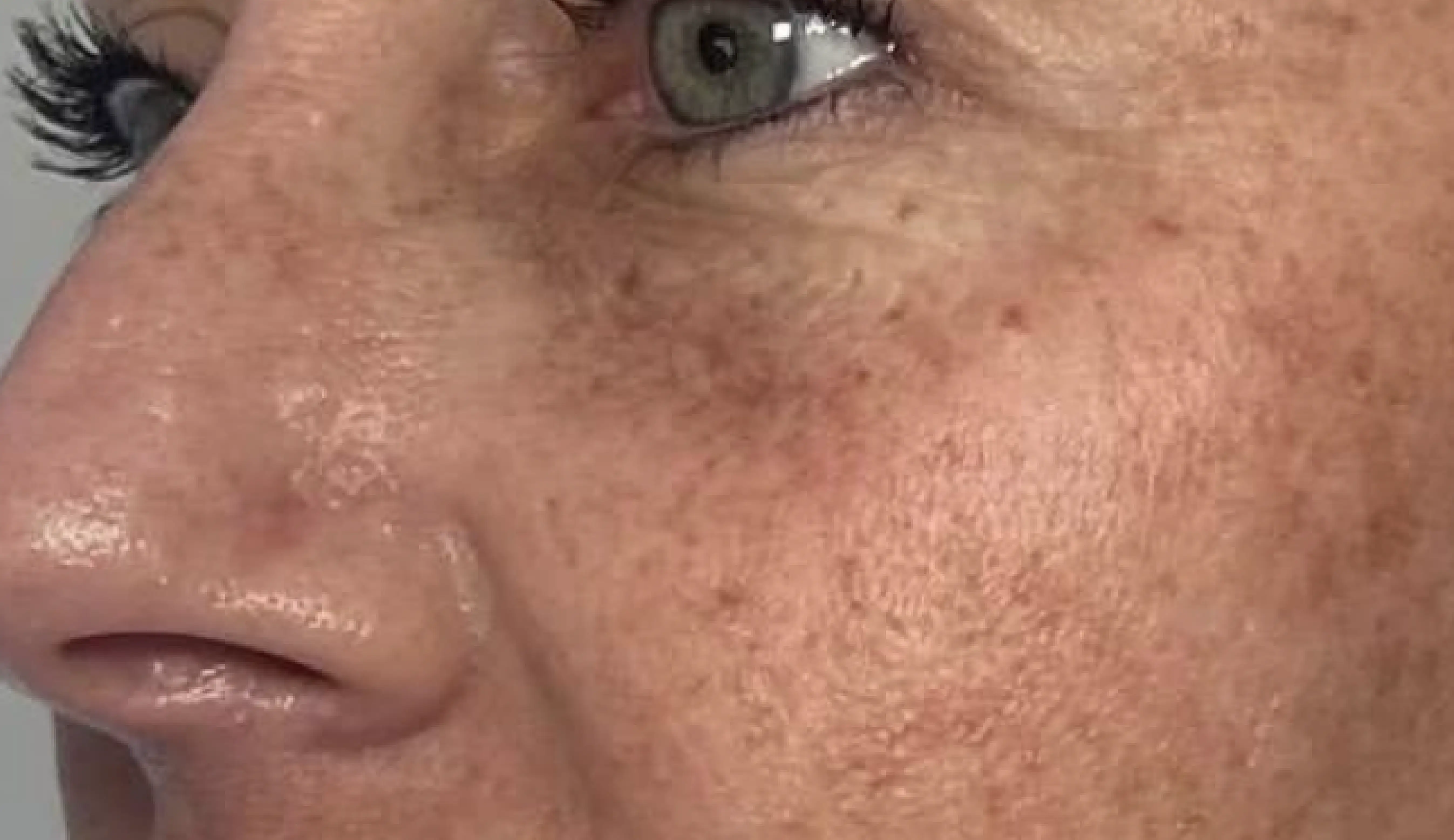 Official Clear + Brilliant patient 1, before treatment