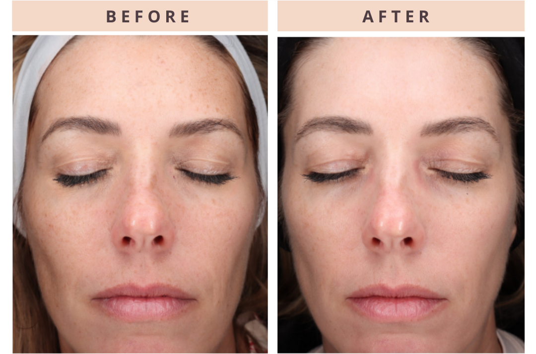 CoolPeel facial result