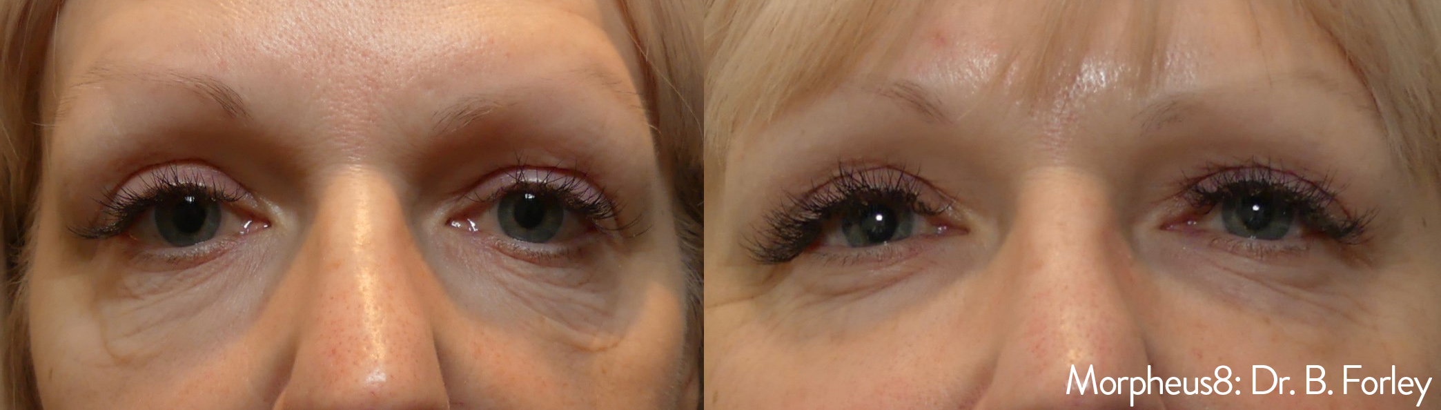 Morpheus8 before and after result