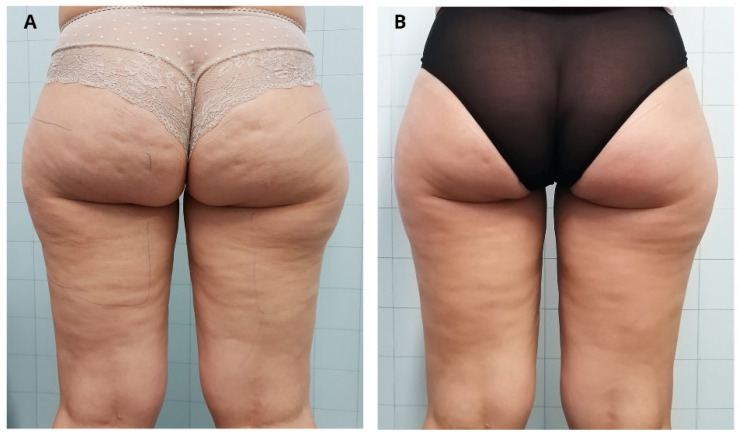 Before and three-month follow-up after ONDA cellulite treatment, side view