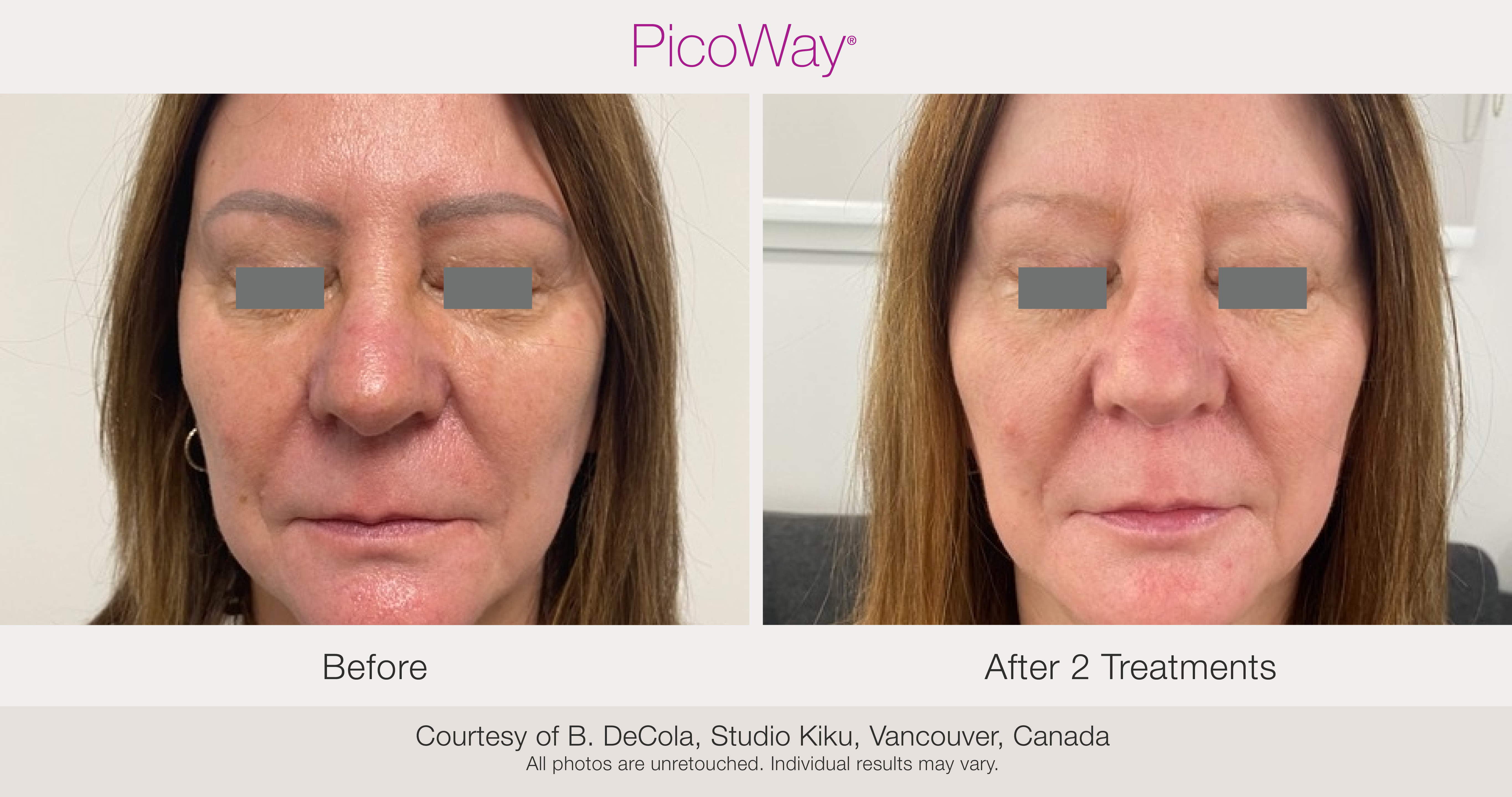 PicoWay at Muse MedSpa