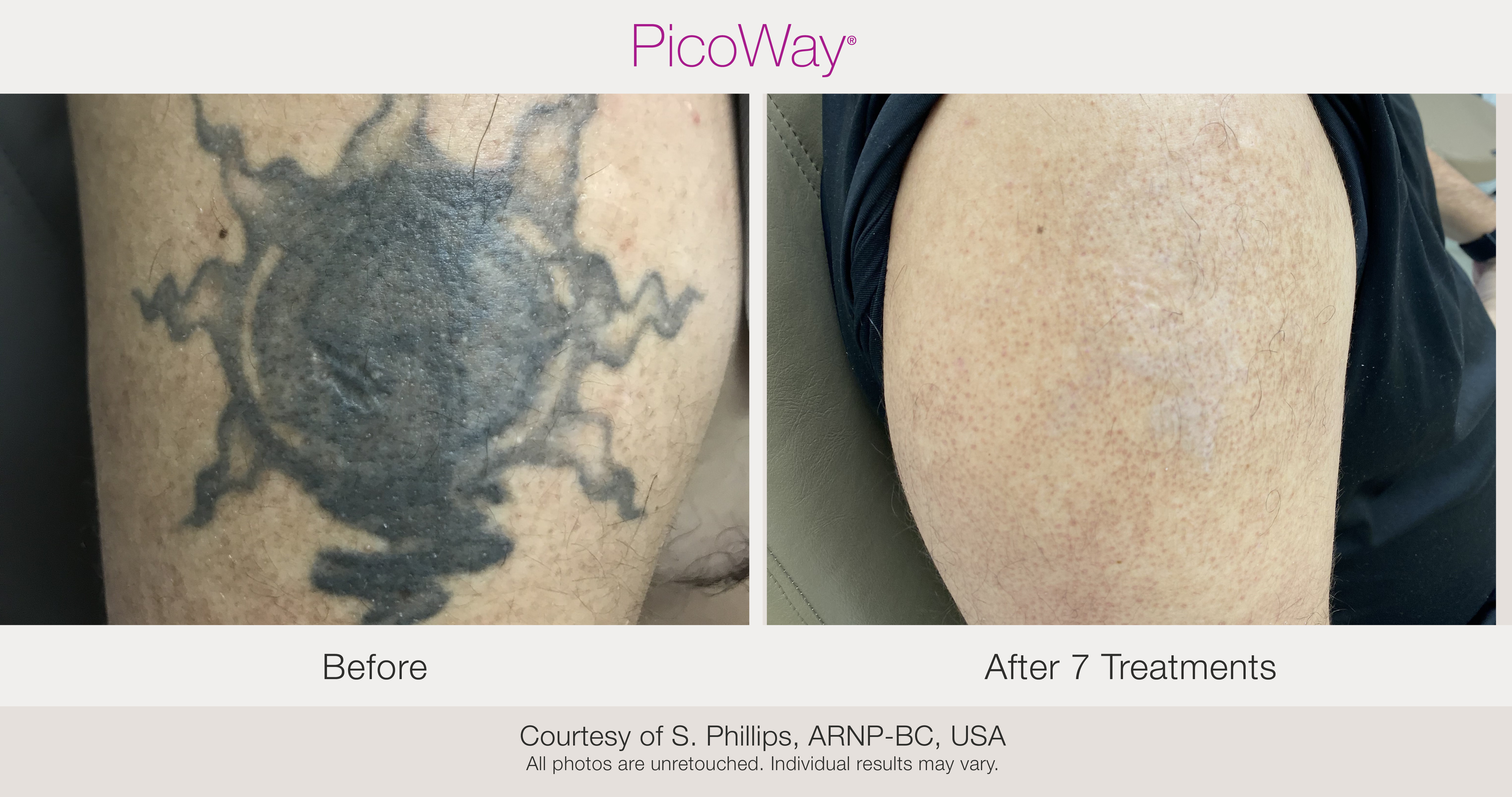 PicoWay pigmentation result