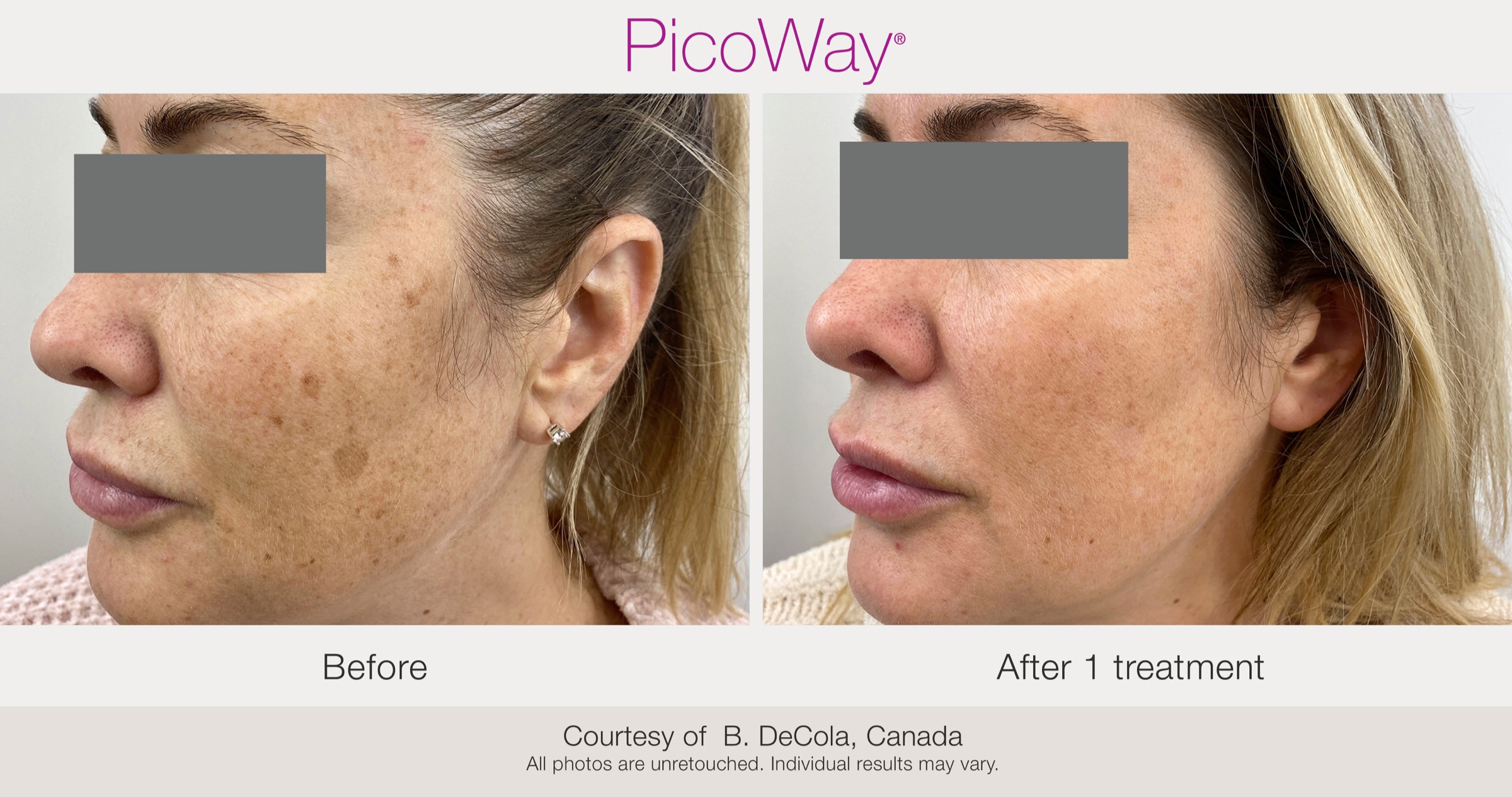 Visible pigment after 1 treatment