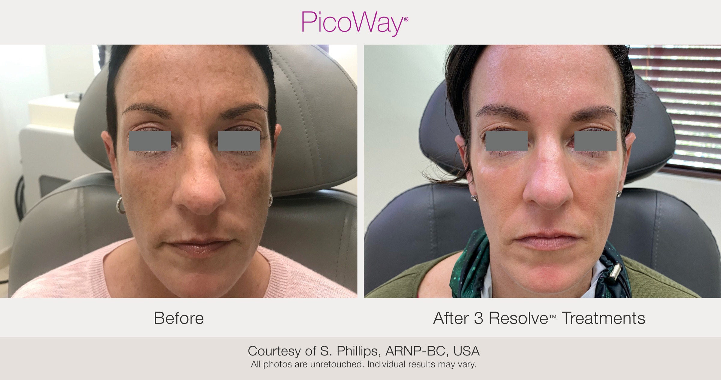 Facial pigment after 3 Resolve treatments