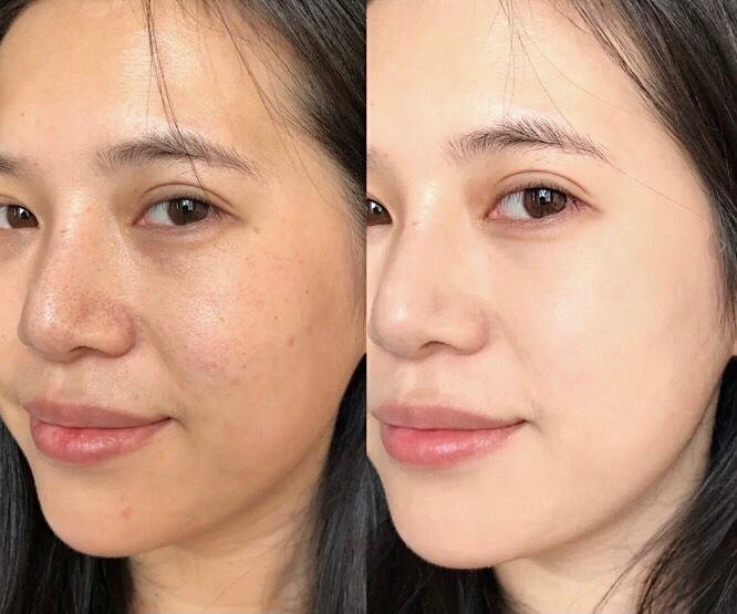Rejuran before and after