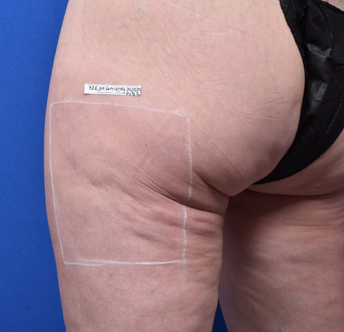 Cellulite appearance: after Sofwave