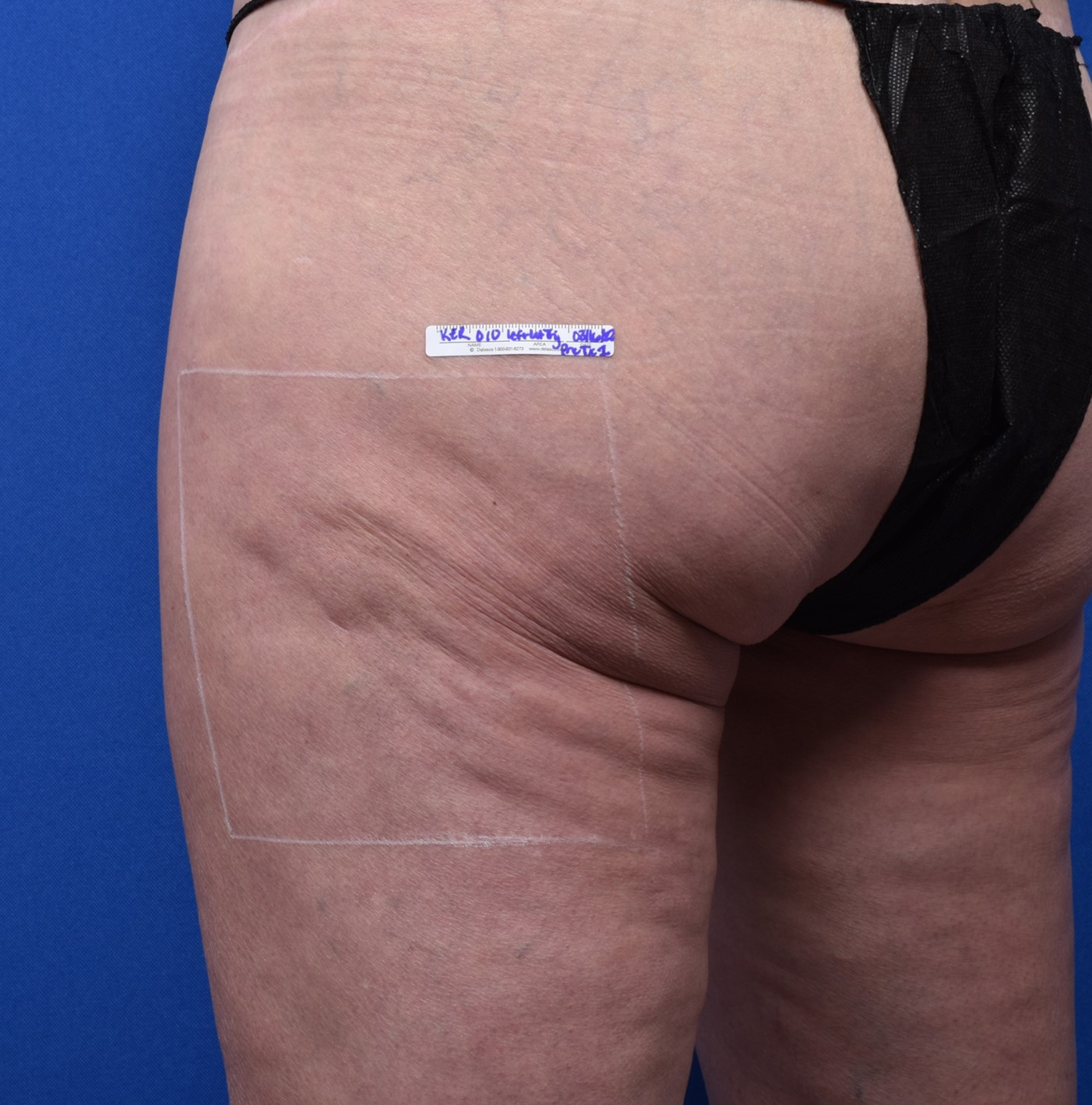 Cellulite appearance: before Sofwave
