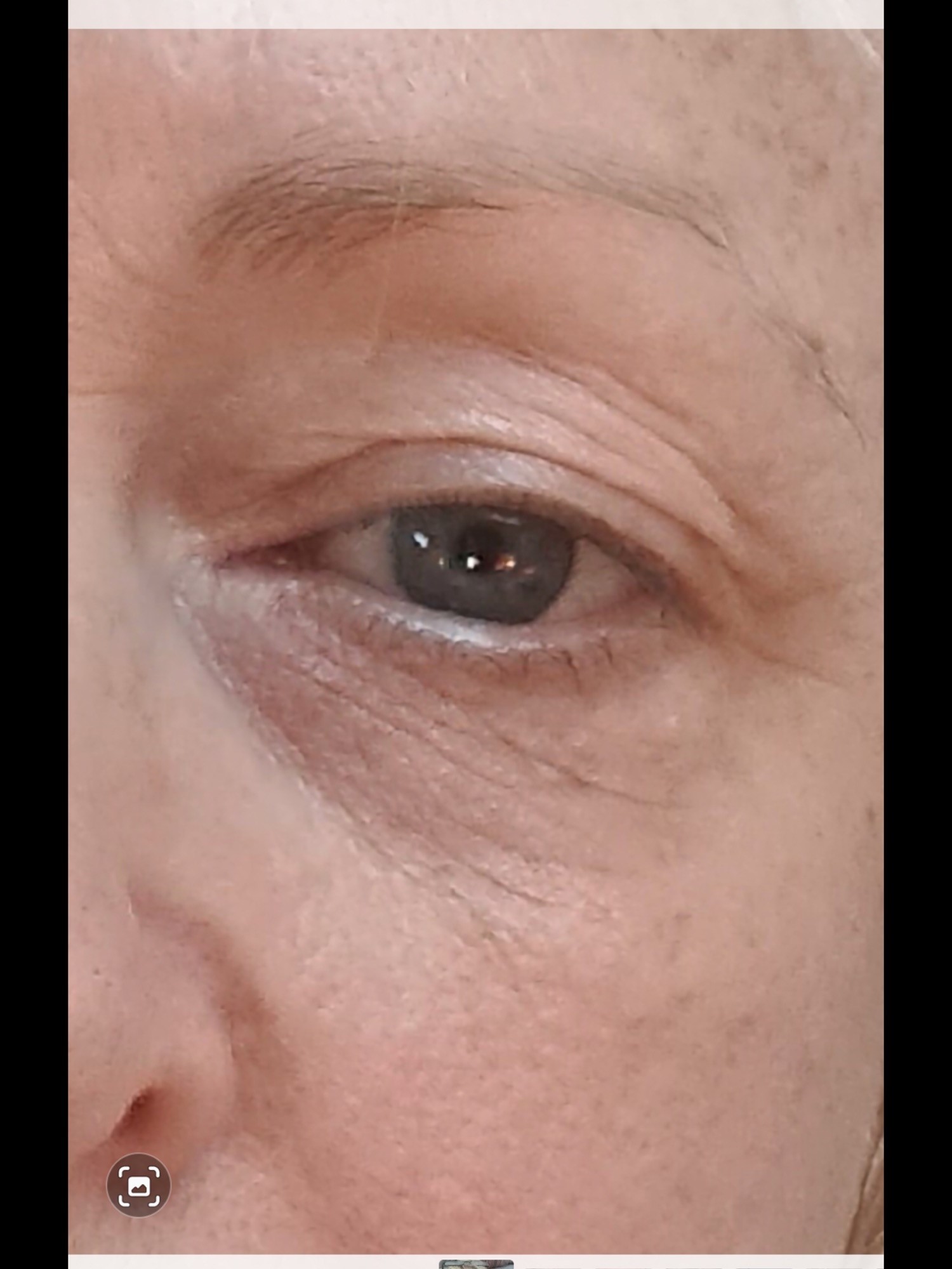 After Sofwave eye treatment
