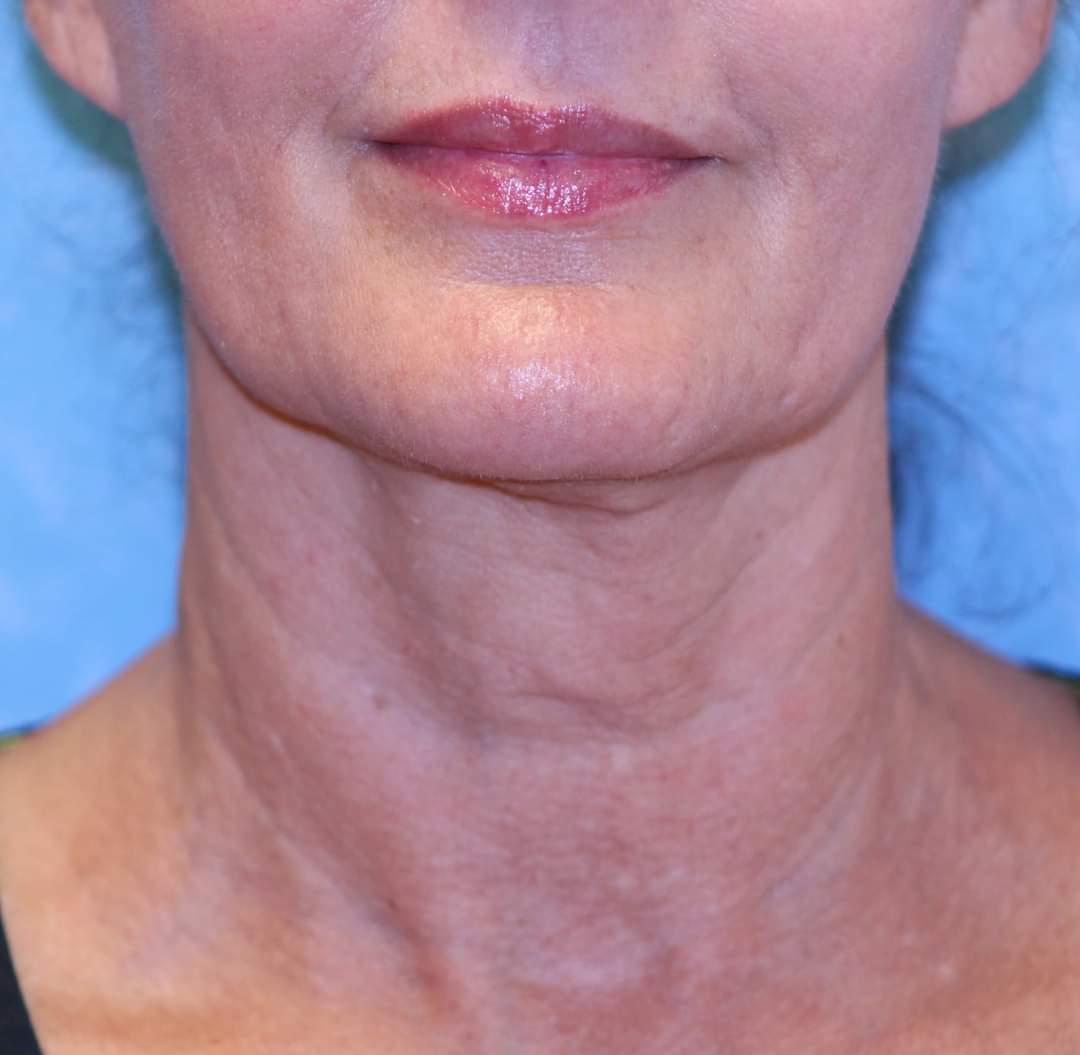 Neck: after Sofwave