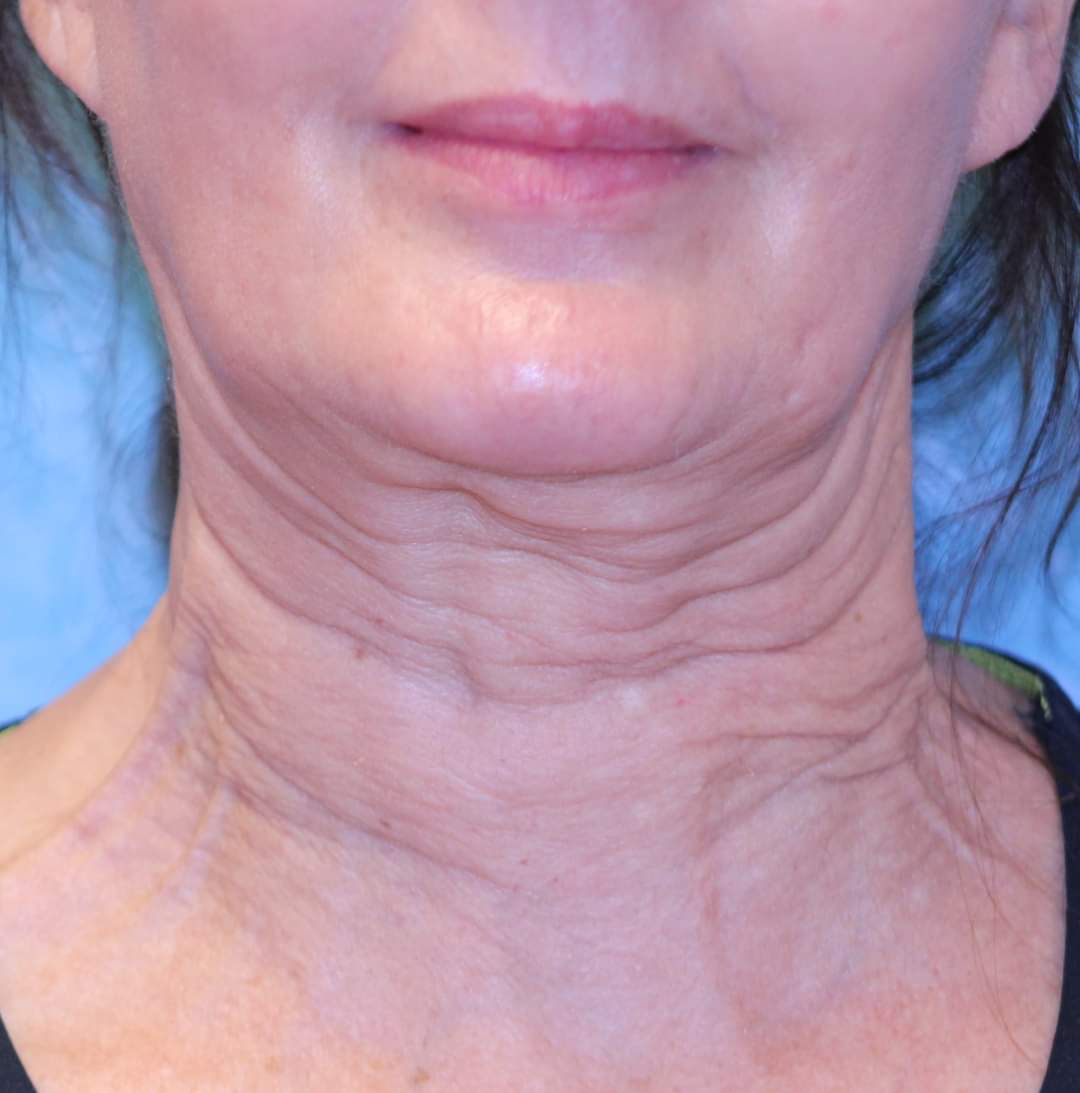 Neck: before Sofwave