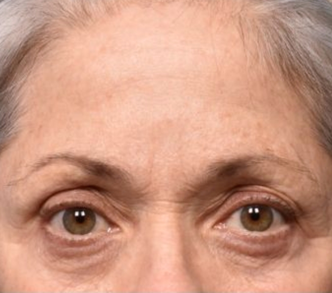 Brow lifting: after Sofwave