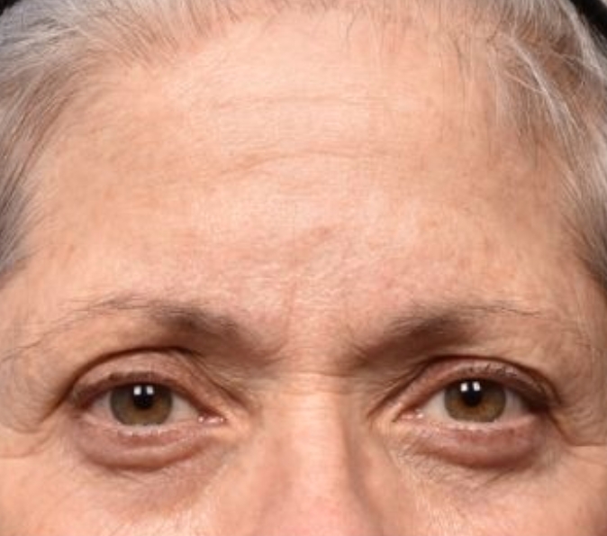 Brow lifting: before Sofwave