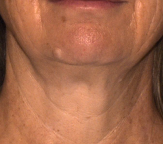 Neck tightening: after Sofwave