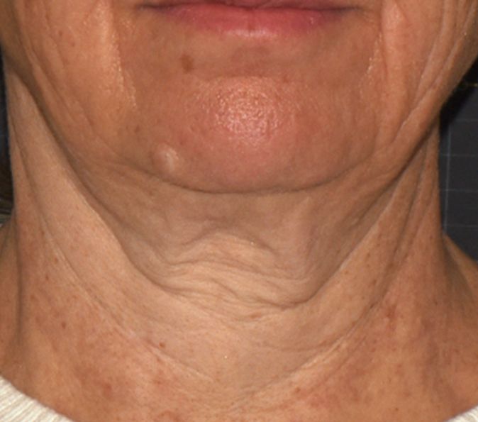Neck tightening: before Sofwave