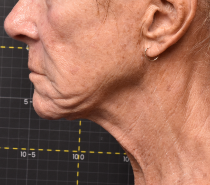 Under the chin: after Sofwave