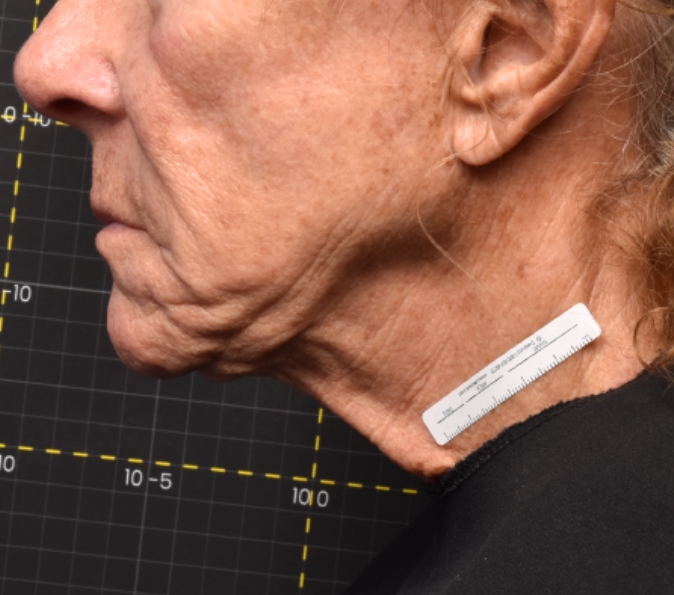 Under the chin: before Sofwave
