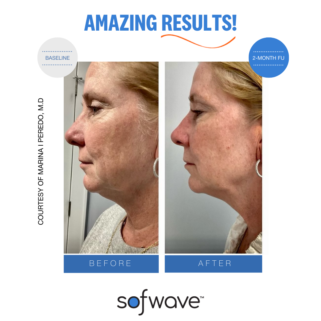 Sofwave facial treatment result