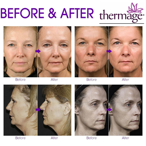 Thermage before and after results