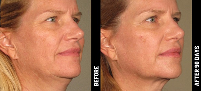 Ultherapy Prime patient result